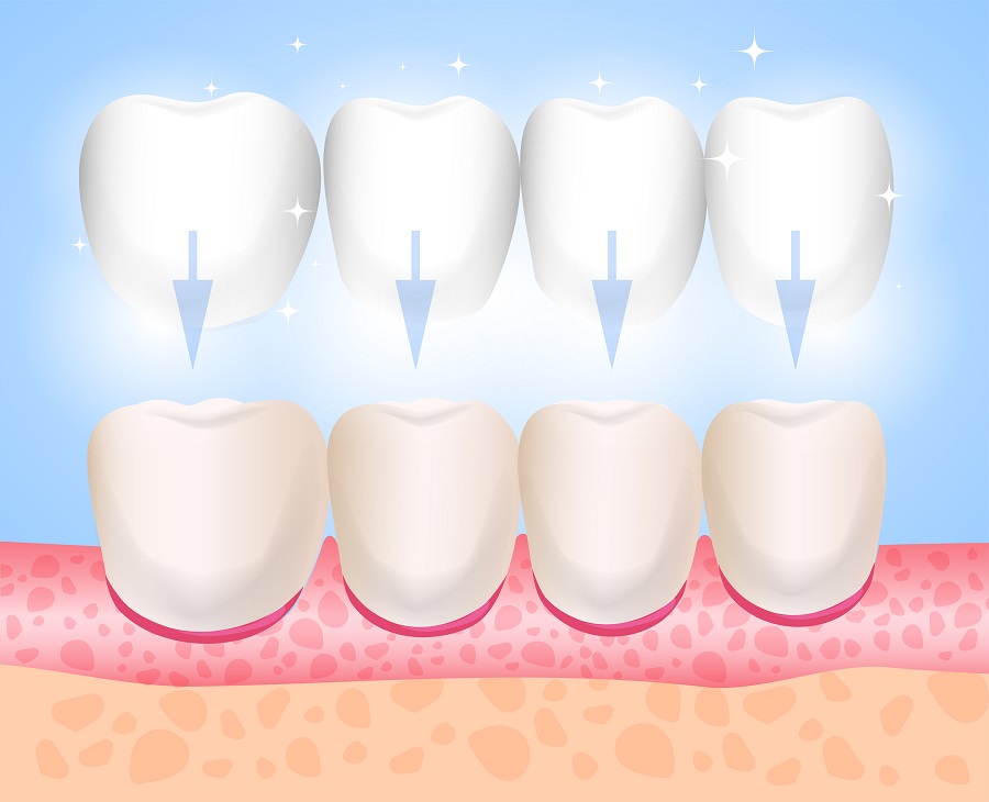 What Are Dental Veneers and What Are Their Benefits?