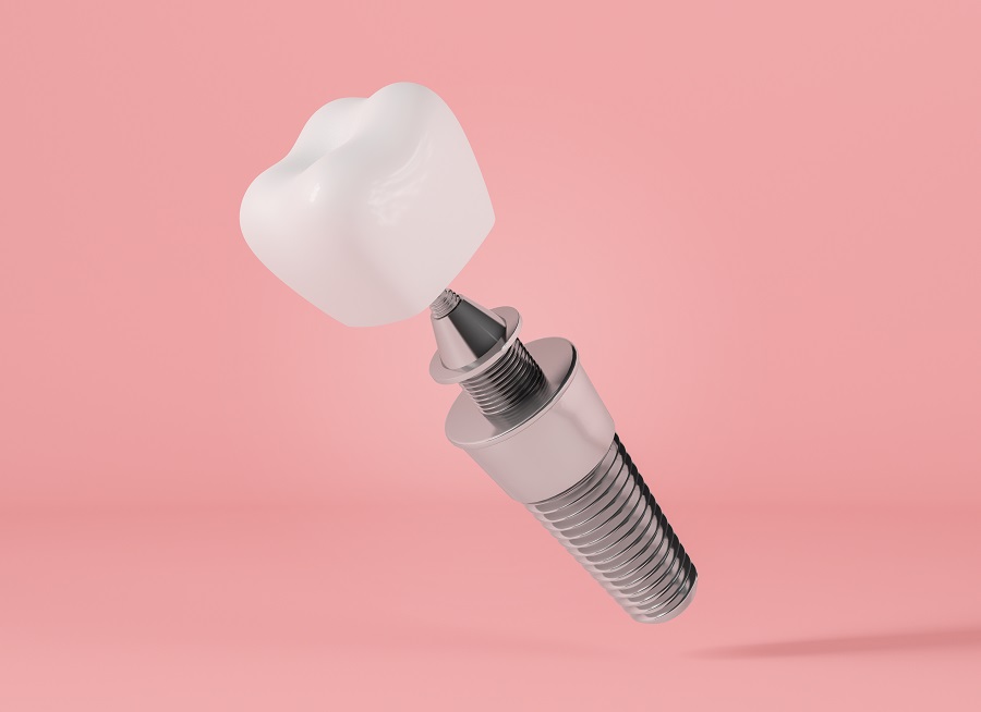 What Are Dental Implants?