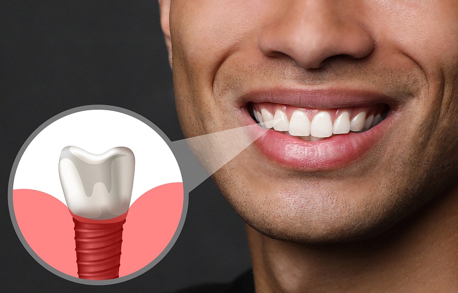 The 4 Benefits of Dental Implants