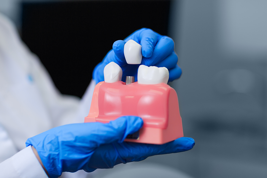 The Benefits of Implant Dentistry: A Permanent Solution for Missing Teeth